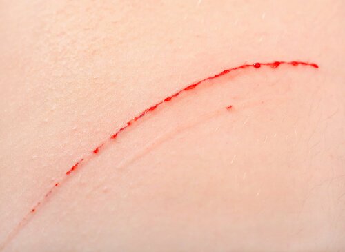 kattekradssyge kan osptå, når man er blevet kradset af en kat