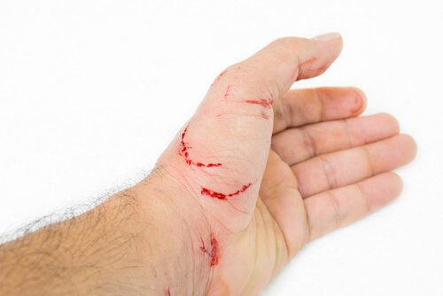 hånd bløder efter at være blevet kradset