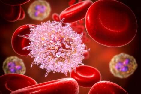 La leucémie provoque une augmentation démesurée des globules blancs. 