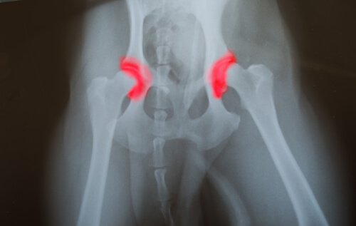 Hip dysplasia