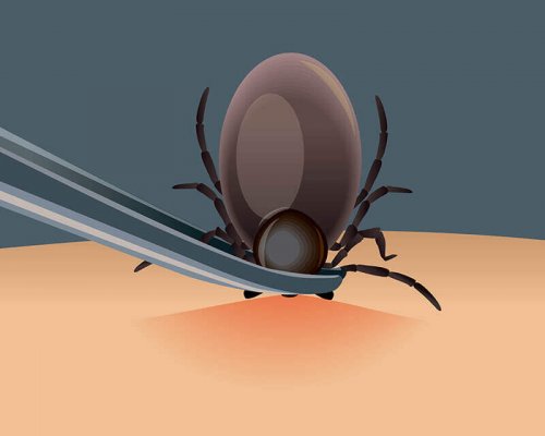 Remove ticks with tweezers.