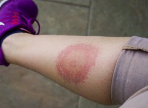 Everything You Need to Know about Lyme Disease