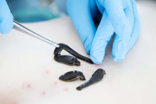 A doctor applying medicinal leeches to someone's body.
