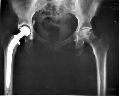An x-ray of a dislocated hip in dogs.